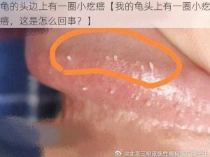 龟的头边上有一圈小疙瘩【我的龟头上有一圈小疙瘩，这是怎么回事？】