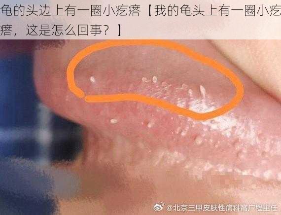 龟的头边上有一圈小疙瘩【我的龟头上有一圈小疙瘩，这是怎么回事？】